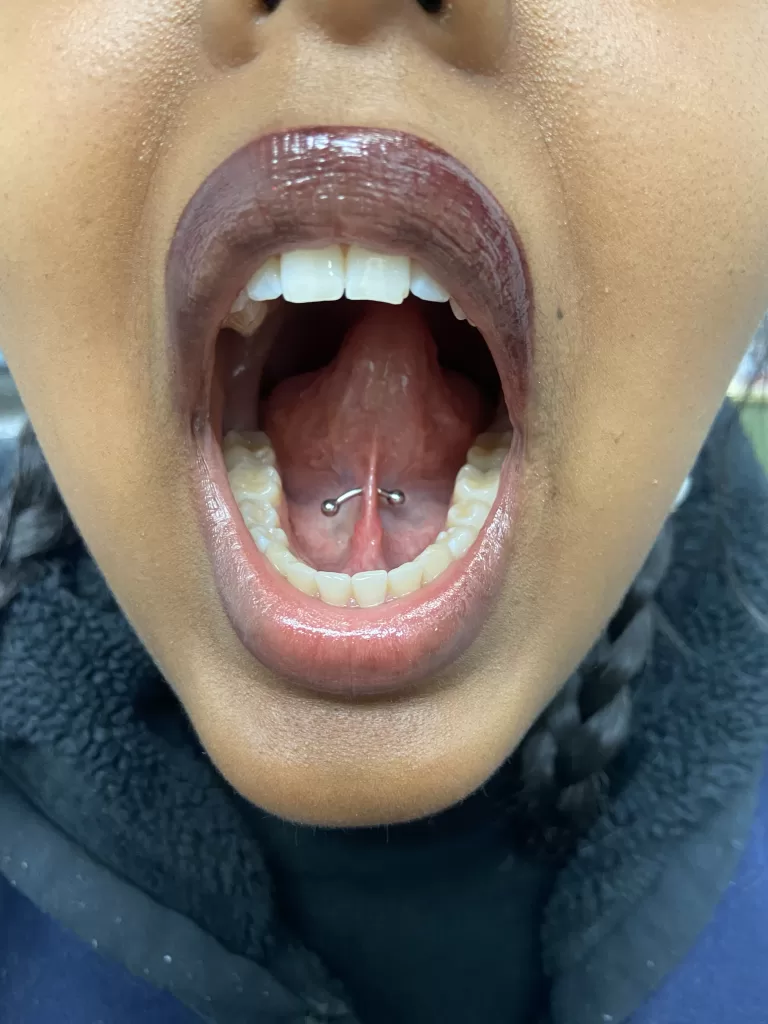 Oral web piercing